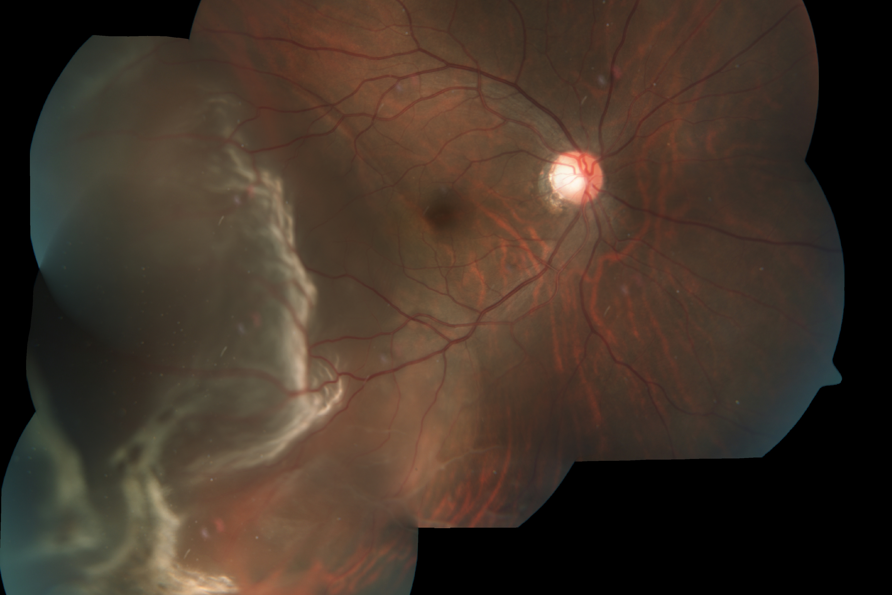 What to do when the first symptoms of retinal detachment What to do when the first symptoms of retinal detachment